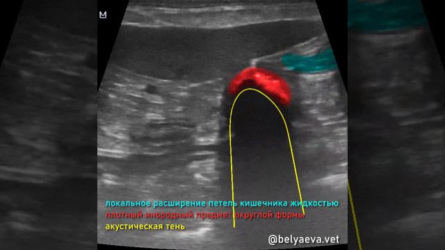 УЗИ инородное тело в кишечнике смотреть онлайн