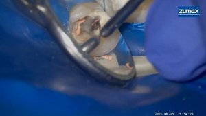 пломбировка корневых каналов. Вертикальная конденсация