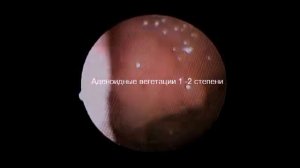 Аденоиды. Эндоскопия