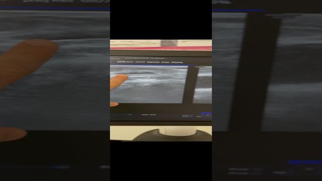 Варикоз на ноге. Лечение варикоза. Как лечить варикоз? Флеболог Москва. Флеболог. Сосудистый хирург смотреть онлайн