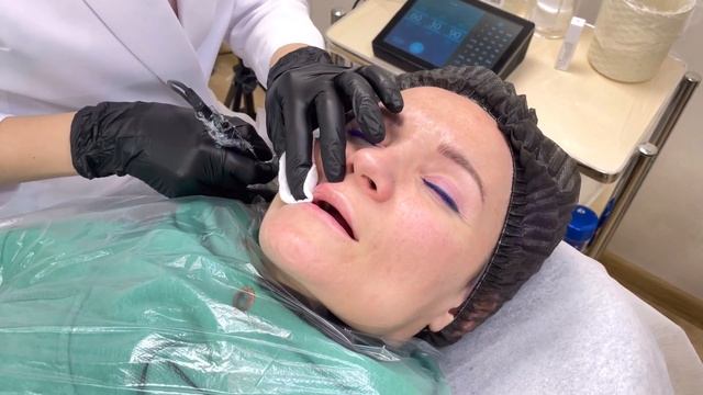 Удаление татуажа губ (легкий способ) при помощи revivink смотреть онлайн