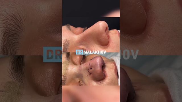 Первичная ринопластика👃🏼Подробный разбор случая вы найдете в моем ТГ-канале, ссылка в описании
