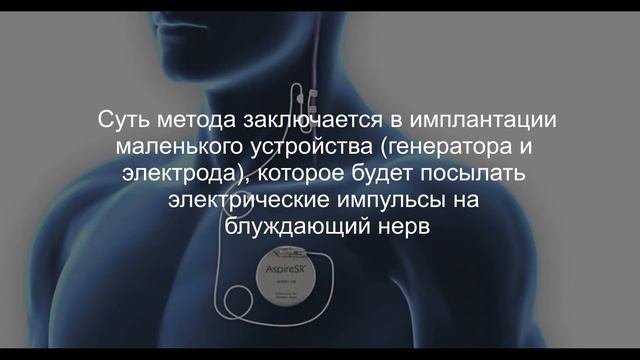 Стимулятор блуждающего нерва (VNS)