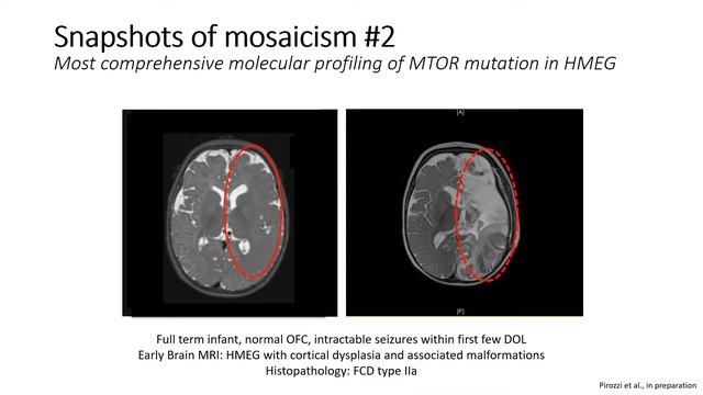 E06.2 Macrocephaly смотреть онлайн