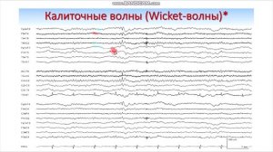 Нормальное ЭЭГ сна