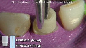 Классическая постановка штифта TopHead in vivo
