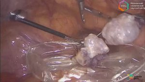 «Лапароскопическая двусторонняя аднексэктомия»