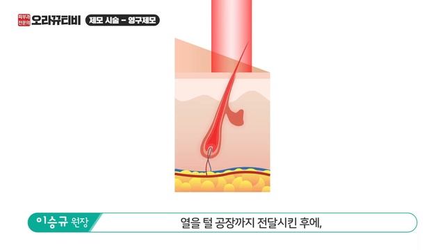(sub)영구제모를 해도 털이 다시 나는 이유!? 영구 제모는 과연 가능한 걸까? смотреть онлайн