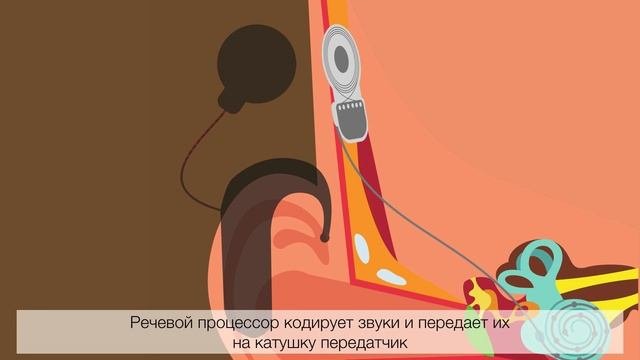Кохлеарная имплантация