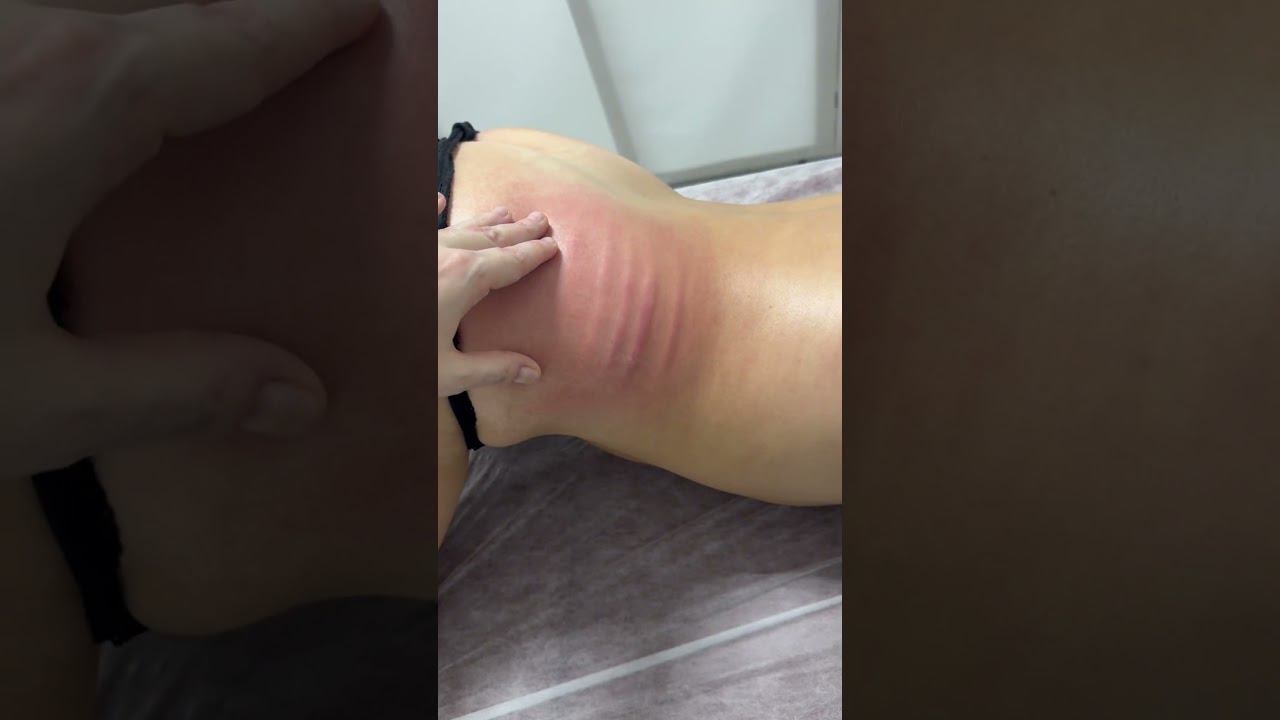 Ручная липосакция зоны боков #shortvideo #похудение #массаж #massage #shorts