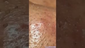 Удаление мелких прыщей пинцетом