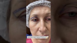 Блефаропластика верхних век