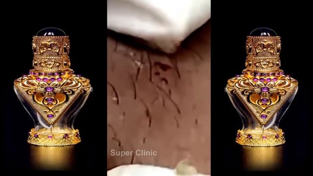 лечение прыщей Удаление черных точек смотреть онлайн