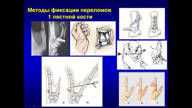 Переломы костей кисти. Лекцияm.