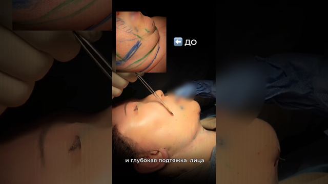 Выполнены #deepnecklift , #deepplanefacelift, #mentoplasty