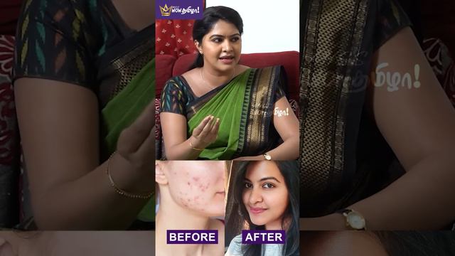 எனக்கு ரொம்ப Pimples இருக்கும் - Rachitha Mahalakshmi #pimpleproblem #skincare #actress #serial