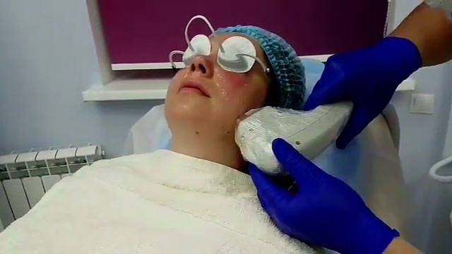 Удаление сосудов на лице в клинике Асклепион смотреть онлайн