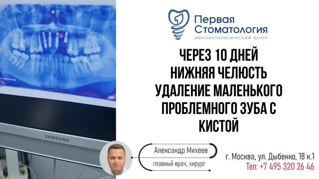В новый год с зубами или как мы сделали новые зубы за 1.5 часа.