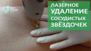 Удаление сосудов лазером. Удаление сосудистых звёздочек лазером. Бест Клиник.
