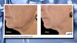 INFINI Lifts and Smooths Skin Without Surgery