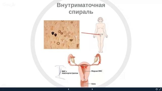 Контрацепция. Как работает внутриматочная спираль (ВМС). Наталья Петрухина