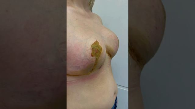 Комплексная операция — редукционная маммопластика + блефаропластика