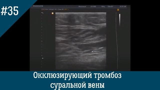 УЗИ вен.  Окклюзирующий тромбоз суральной вены.