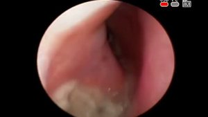 #ОПУХОЛЬ НОСА #ГАЙМОРОВОЙ ПАЗУХИ ДИАГНОСТИКА ЛЕЧЕНИЕ #ОНКОЛОГИЯ КИЕВ КЛИНИКА ОБРАЗЦОВА