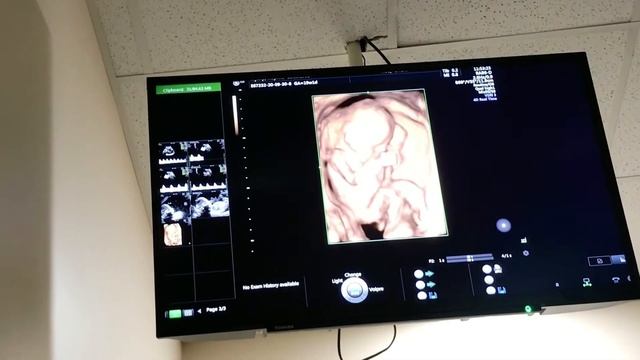 Скрининг Второго Триместра Беременности смотреть онлайн