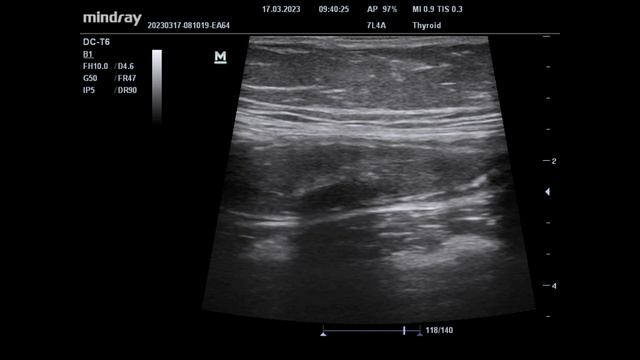 УЗИ ОБП. Аппендицит. смотреть онлайн