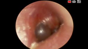 Острый средний отит #инфекция #носа носоглотки и #уха