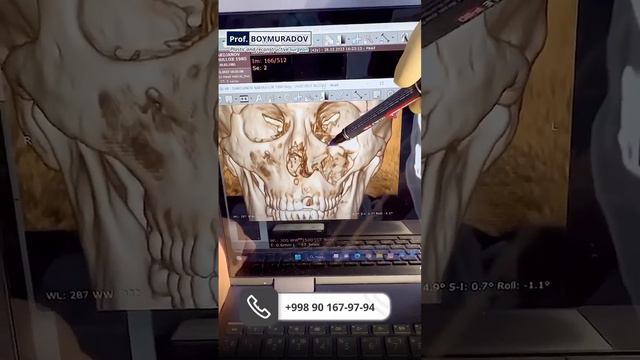 У пациента ТРАВМА нижней стенки орбиты, а также ПЕРЕЛОМ кости носа. смотреть онлайн