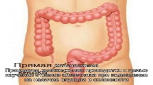 Тубулярная аденома толстой кишки