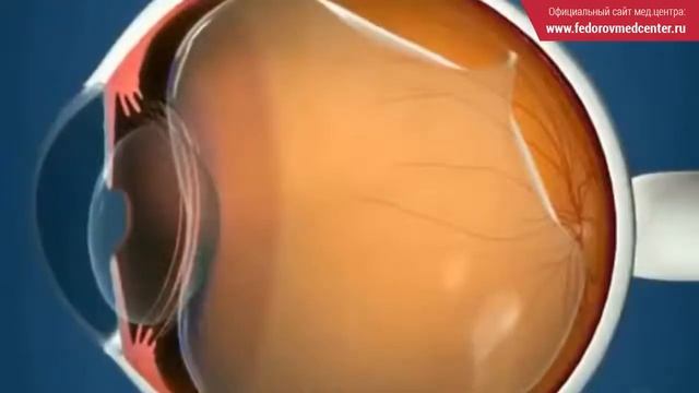 Вспышки света и черные пятна. Возможно это отслойка стекловидного тела смотреть онлайн