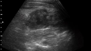 забрюшинная гематома