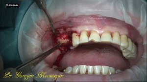 Др. Гарегин Мовсесян . Из старых работ. Навигационная дентальная имплантация