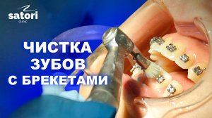 Чистка зубов с брекет-системой