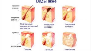 Виды прыщей. Какие бывают прыщи?