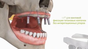Протезирование в концепции Straumann®️ Pro Arch с опорой на имплантаты Straumann®️ BLX