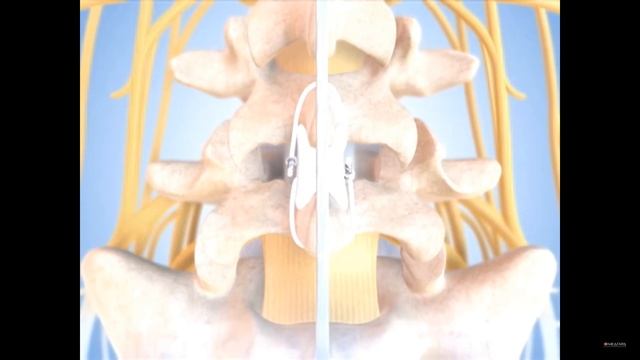 Межостистый имплантант DIAM MEDTRONIC мне не помог смотреть онлайн