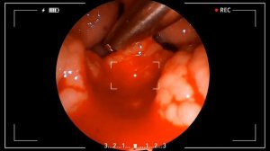 Аденоидные вегетации 3й степени. Эндоскопическая шейверная аденотомия. #лорврач #аденоиды #ангина