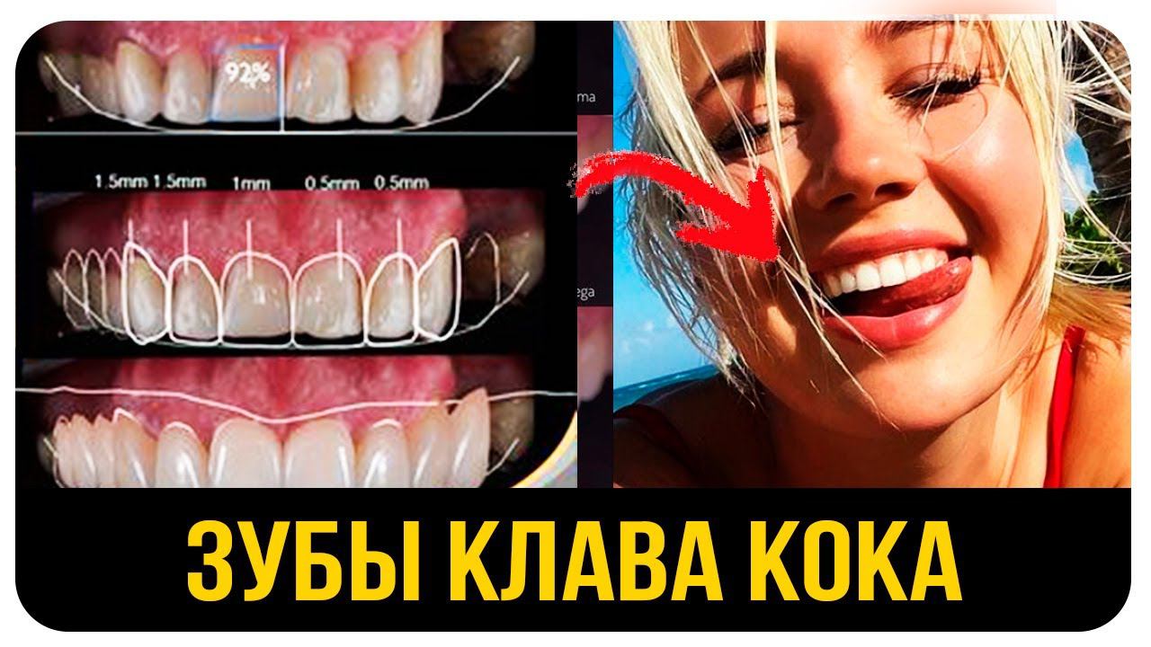 Клава Кока. До и После. Кривые Зубы Знаменитостей. Сколько Стоит Исправление Прикуса?