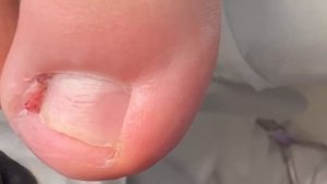 Вросший ноготь у подростка. Реакция ребенка на удаление!