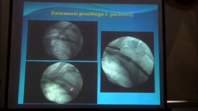 Dostęp żylny uzyskiwany przez nakłucie żyły-J.Blicharz смотреть онлайн