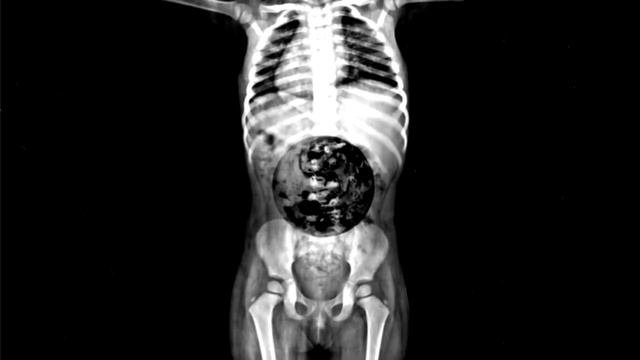 SCP-007 "Abdominal Planet" - SCP FOUNDATION - SCP Creatures