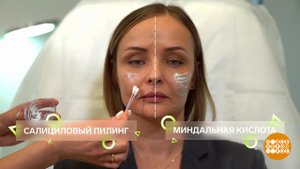 Все про кислотный пилинг. Доброе утро. Фрагмент выпуска от 21.03.2024
