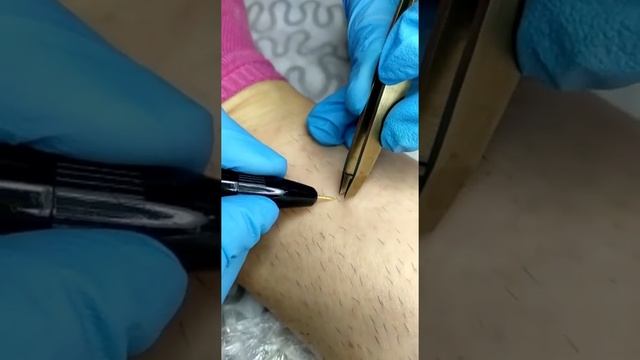 Электроэпиляция# смотреть онлайн