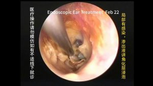 Review and cleaning of two types of cholesteatoma