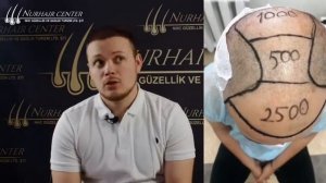 Пересадка волос уже в Казани ?