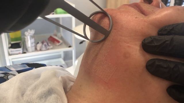 Лазерная шлифовка лицо и шея смотреть онлайн